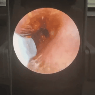 Orion™ Earwax Removal Kit