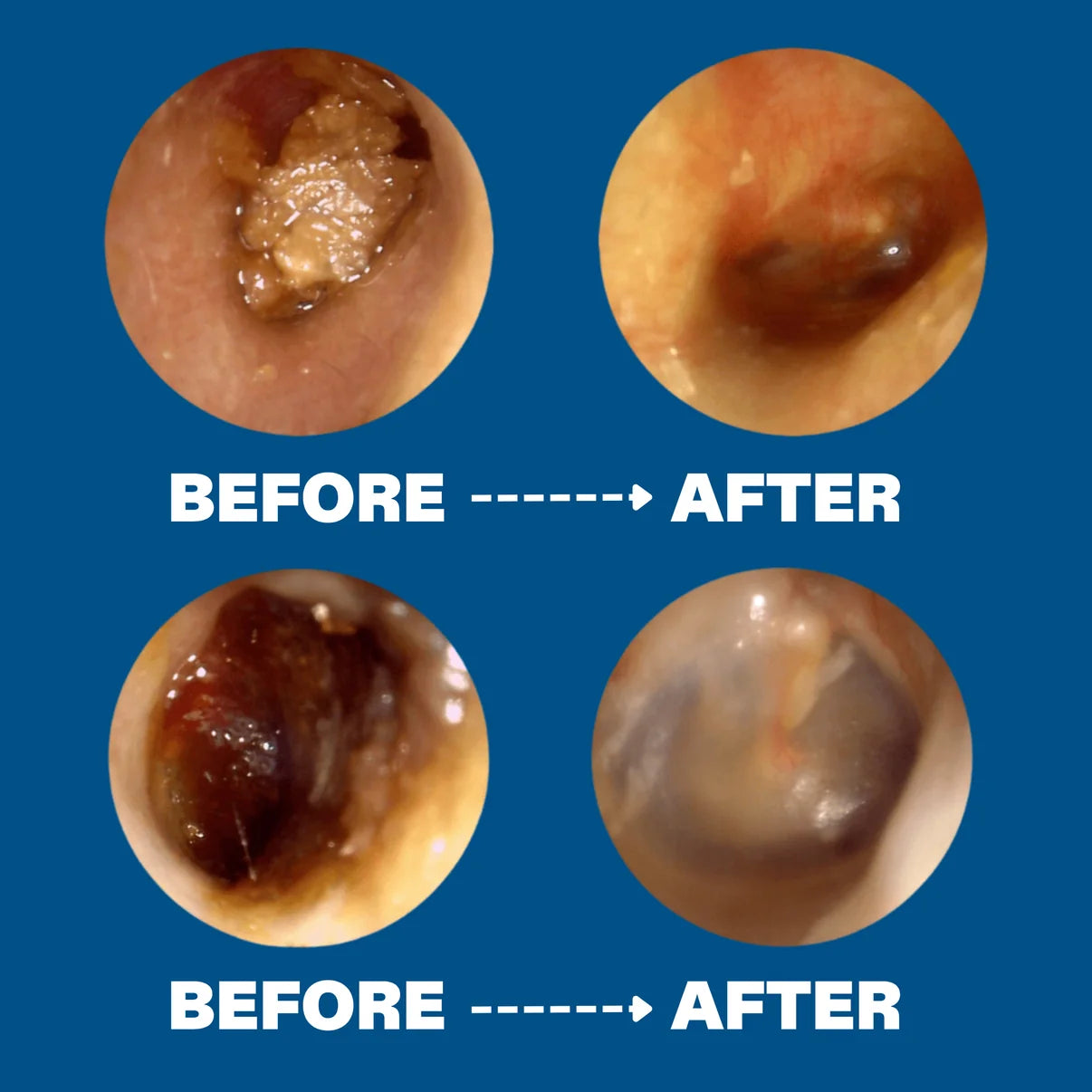 Orion™ Earwax Removal Kit