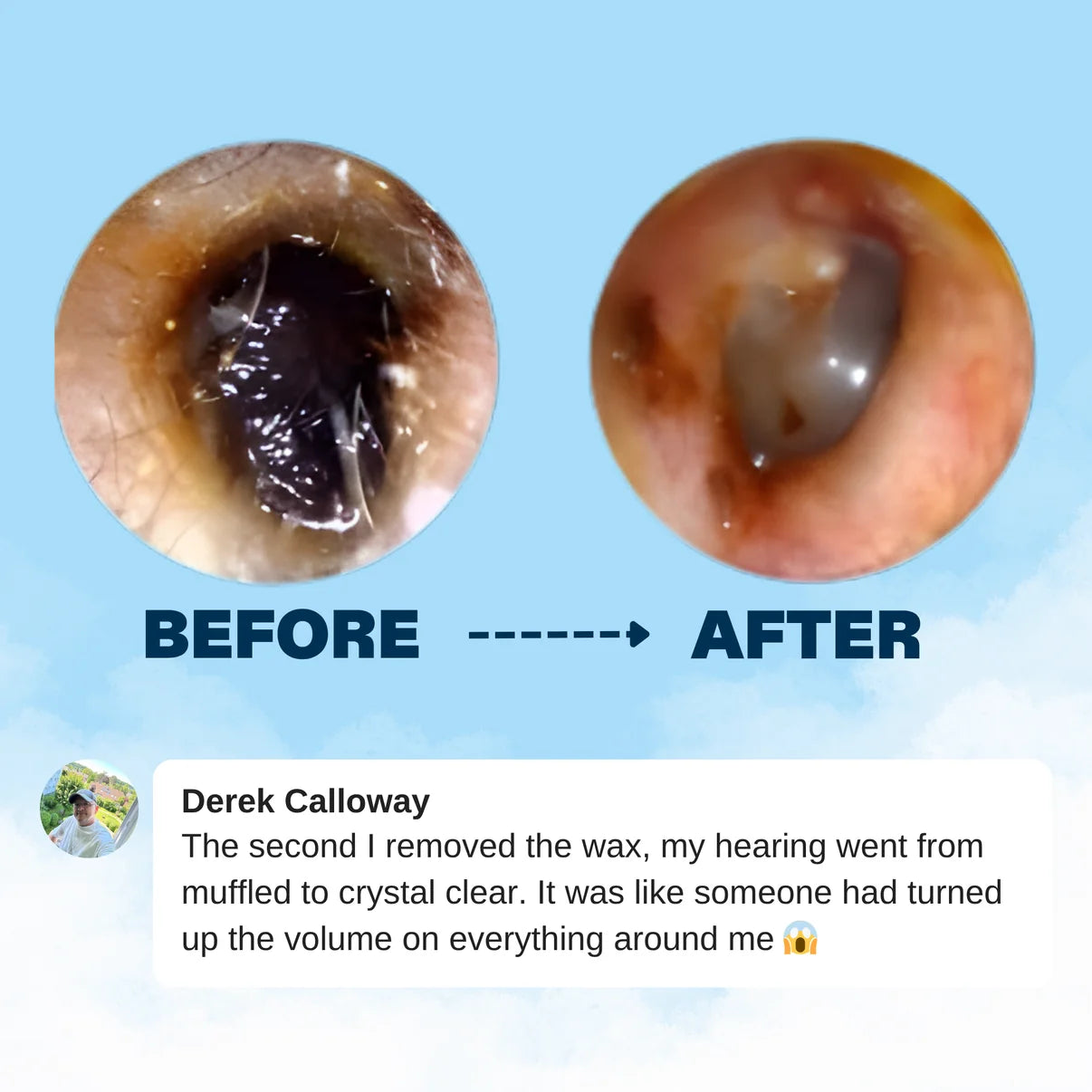 Orion™ Earwax Removal Kit