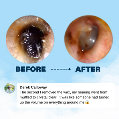 Orion™ Earwax Removal Kit